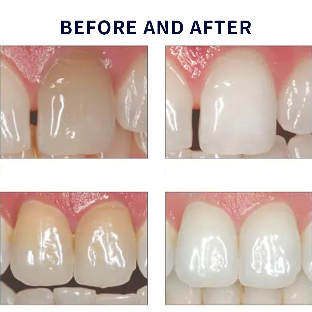 Opalescence beyazlatma 20% PF  - Teeth Whitening Near Me incelemesi ve fiyatı
