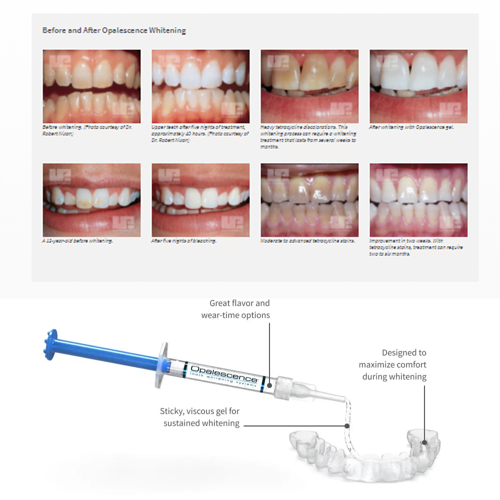 Opalescence beyazlatma 20% PF  - Teeth Whitening Near Me incelemesi ve fiyatı