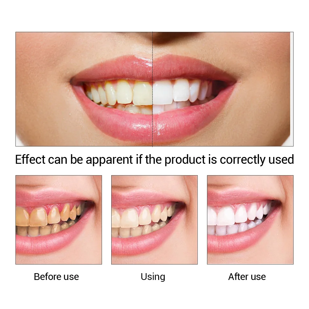 FTEENPLY diş beyazlatma özü to - Teeth Whitening Q&M incelemesi ve fiyatı