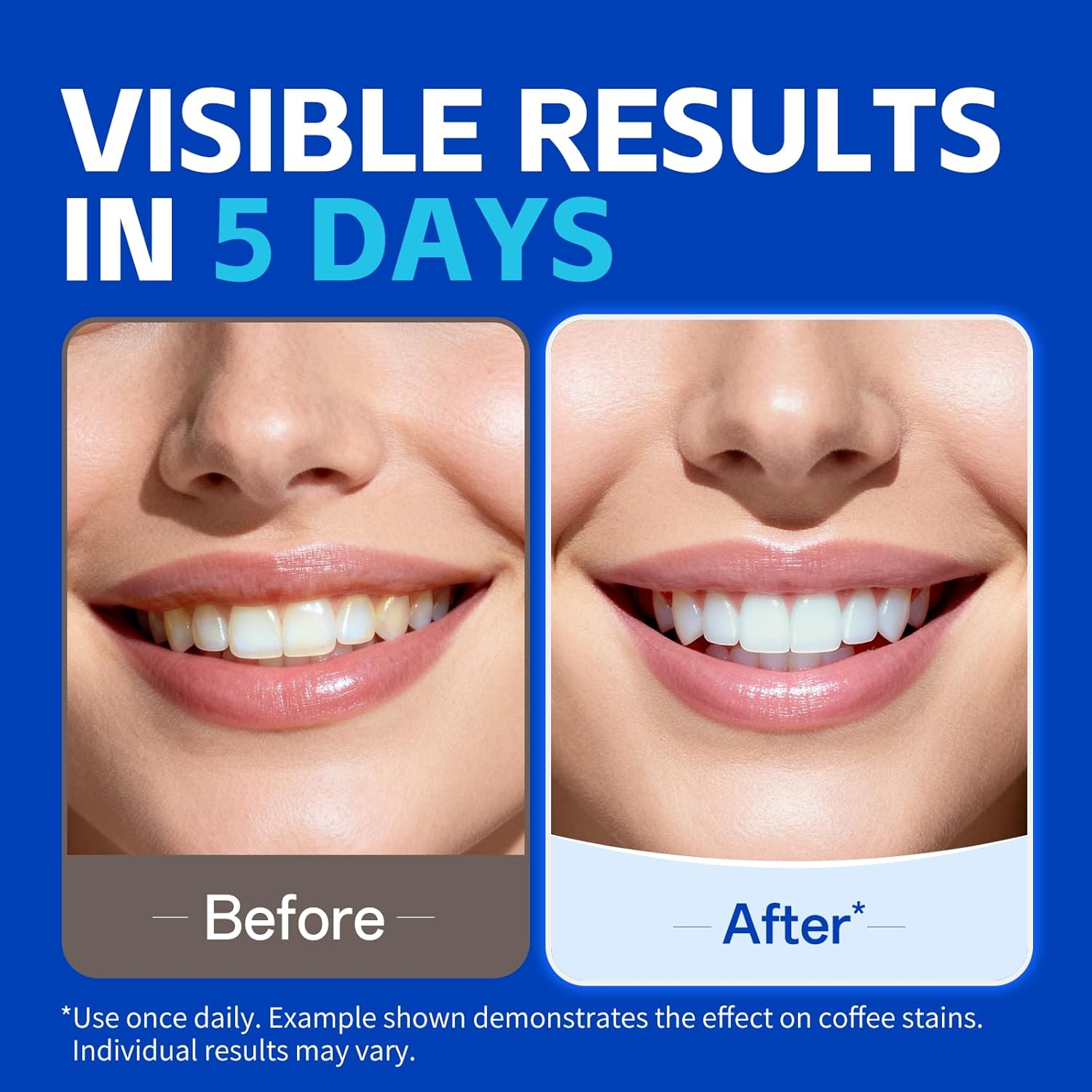 Daha Beyaz Görünümlü Bir Gülüm - Teeth Whitening Retainer incelemesi ve fiyatı